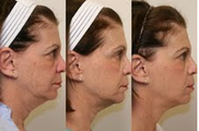 Ultherapy of the Full Face