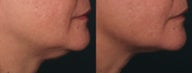Ulthera Laser Skin Tightening