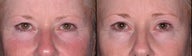 Ulthera Laser Skin Tightening