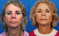 Ultherapy