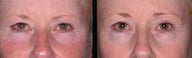Ultherapy