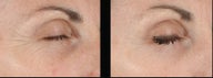Ultherapy