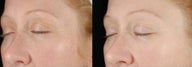 Ultherapy