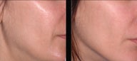 Ultherapy
