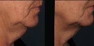 Ultherapy