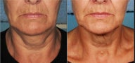 Ultherapy