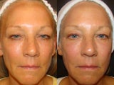 Ultherapy