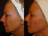 Ultherapy