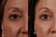 Ultherapy