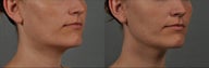 Ultherapy