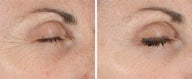 Ultherapy of Eyes and Neck