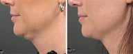 Ultherapy
