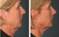 Ultherapy Treatment
