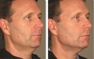 Ultherapy