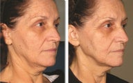 Ultherapy