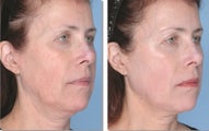 Ultherapy