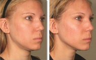 Ultherapy