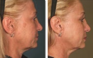 Ultherapy