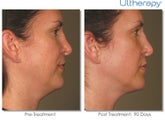 Ultherapy