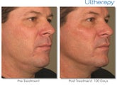 Ultherapy