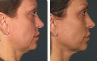Ultherapy