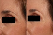 Ultherapy Eyelid Lift