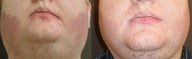 Treatment for port wine stain