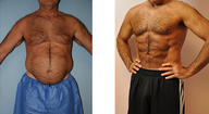 VASER Hi Def Liposuction (LipoSculpture)