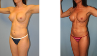 Vaser Hi Def LipoScuplture (Liposuction)