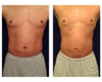 Liposuction