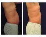 Liposuction