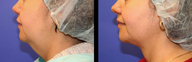 Vaser Liposuction