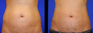 Vaser Liposuction