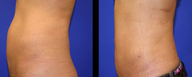 Vaser Liposuction