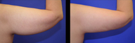 Vaser Liposuction