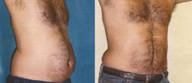 Liposuction