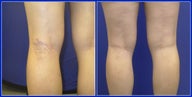 spider vein sclerotherapy with asclera