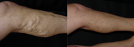 Vein Treatment