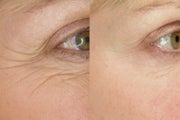 Botox for Wrinkle Treatment