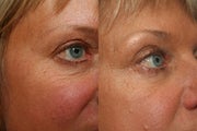 Non-Invasive Wrinkle Treatment
