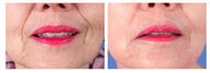 Restylane for nasolabial folds