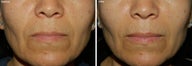 Fillers for Nasolabial Folds
