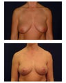 Breast Lift / Mastopexy