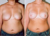 Mastopexy-Breast Lift