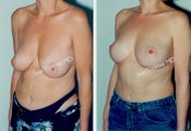 Mastopexy-Breast Lift