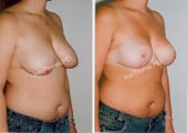 Mastopexy-Breast Lift
