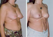 Mastopexy-Breast Lift