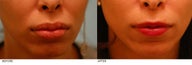 Silicone Lip Correction/Reduction