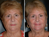 Laser Resurfacing