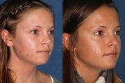 PDT Before and After